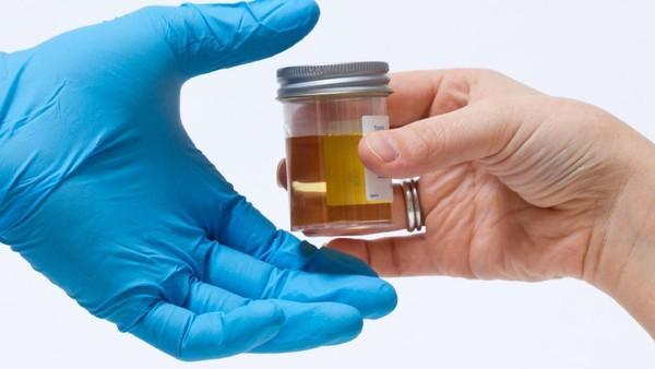 Operasi Tes Urin di Perusahaan Sawit: 8 Karyawan Terjaring